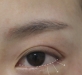 비절개 뒤·밑…