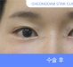 비절개 눈성형