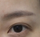 비절개 뒤·밑…